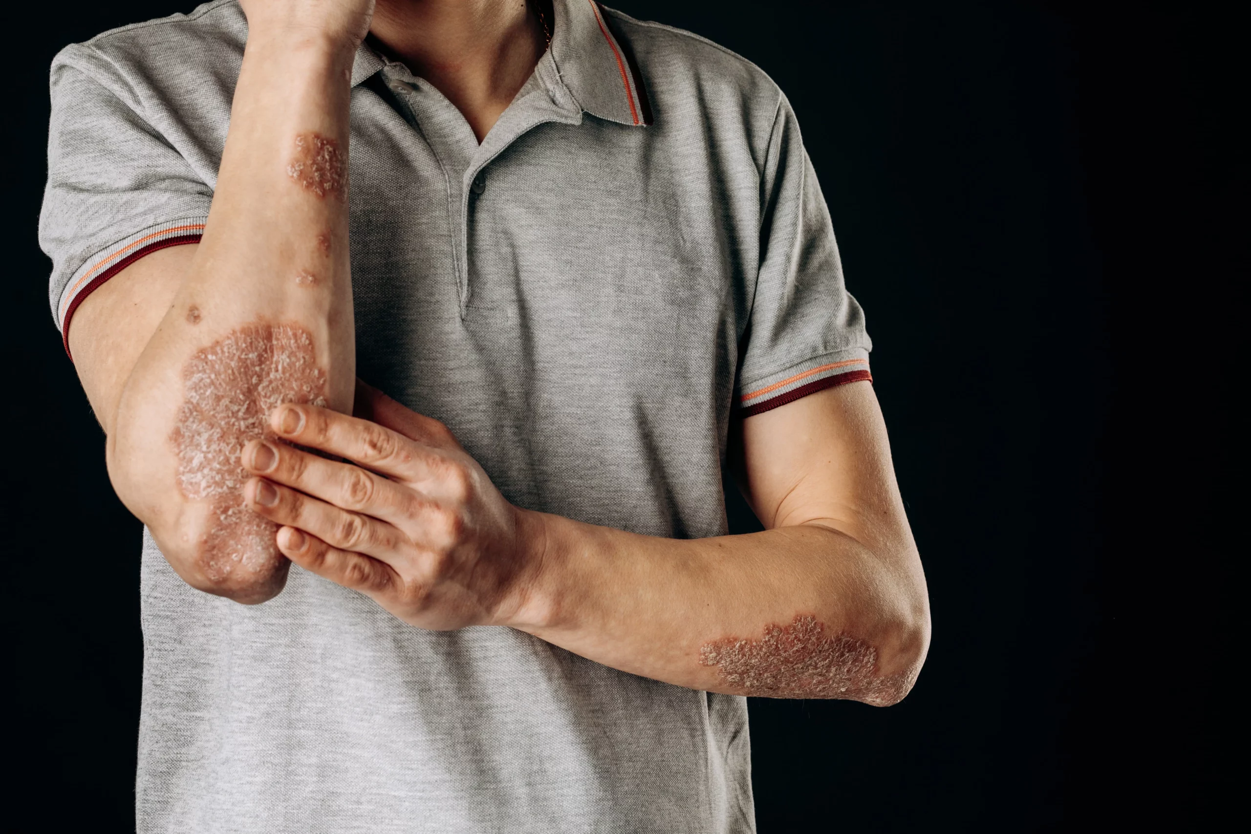 What is Eczema? Causes, Types | Complete Guide to Skin Care